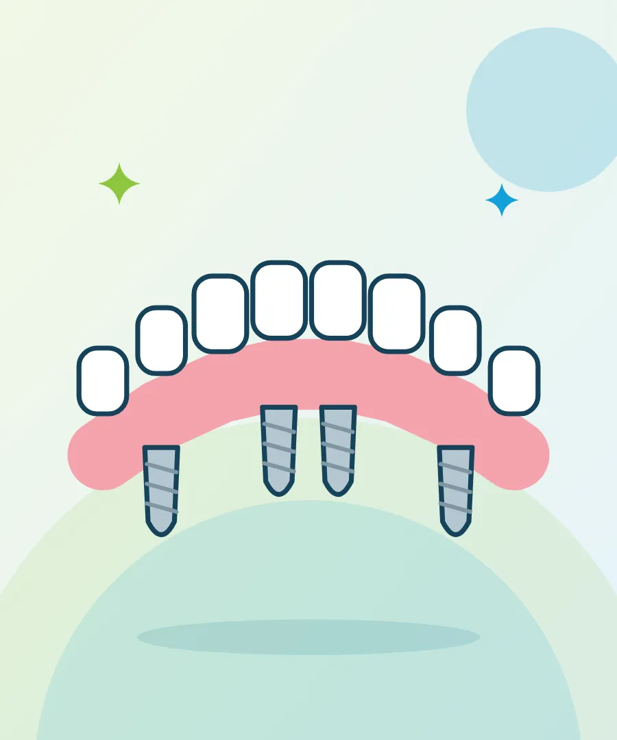 Illustration of a fixed full-arch bridge held by four implants for All-on-4 dental implants at Sai Multi Speciality Dental Clinic, Baner