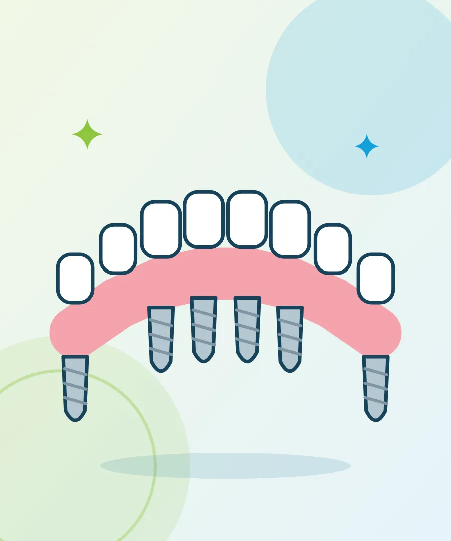 Illustration of a fixed full-arch bridge held by six implants for All-on-6 dental implants at Sai Multi Speciality Dental Clinic, Baner