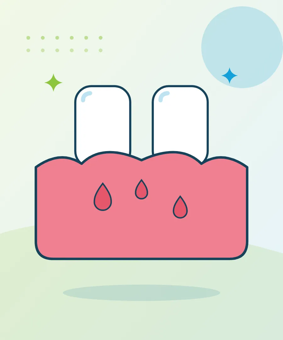 Illustration of inflamed gums around two teeth for bleeding gums treatment at Sai Multi Speciality Dental Clinic, Baner