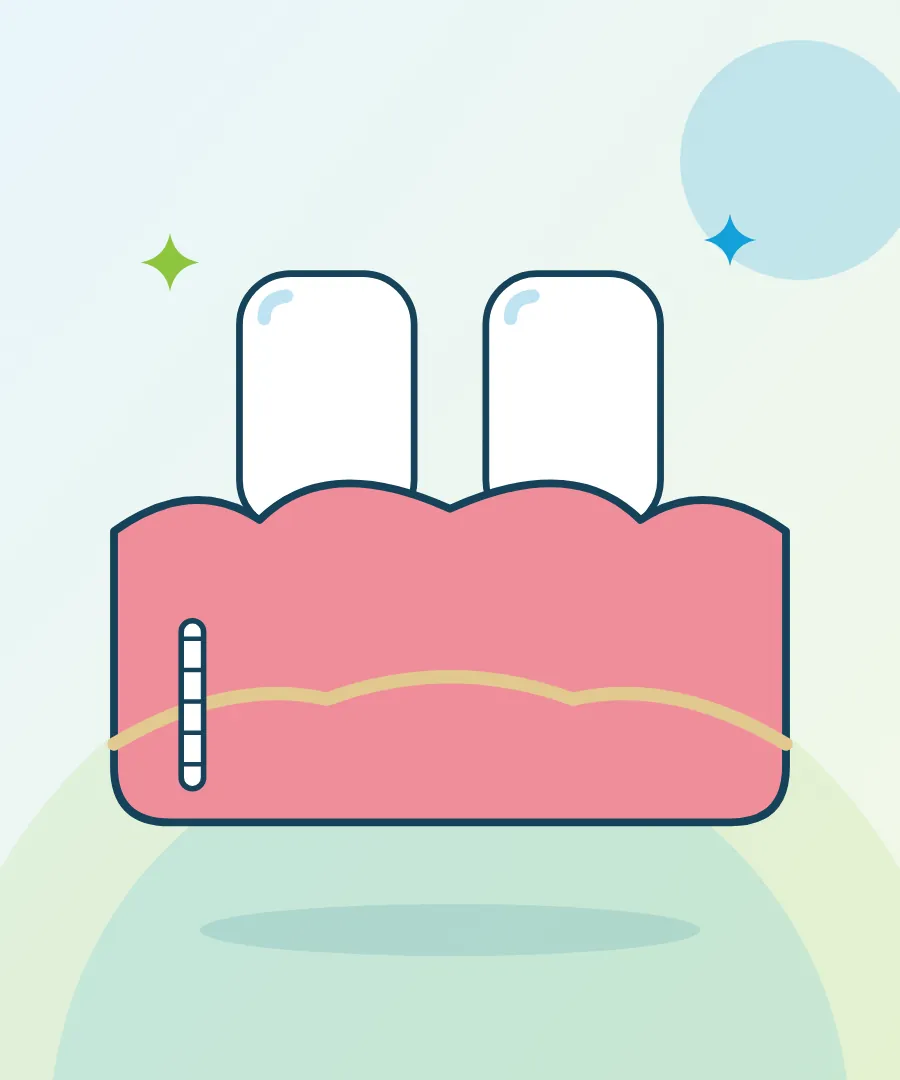 Illustration of gum pockets cleaned below the gum line for deep cleaning at Sai Multi Speciality Dental Clinic, Baner