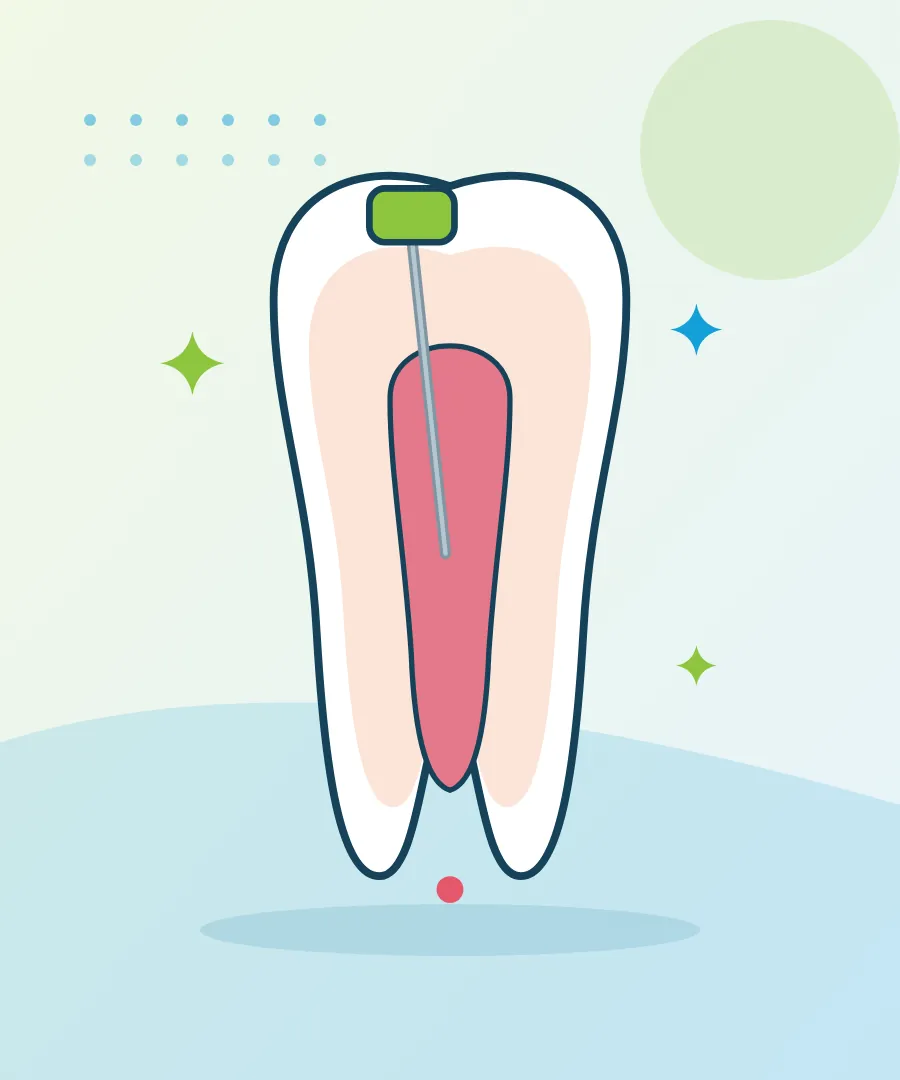 Illustration of a cross-section of a tooth with the root canal and a fine file for Dr archana satpute, endodontist at Sai Multi Speciality Dental Clinic, Baner