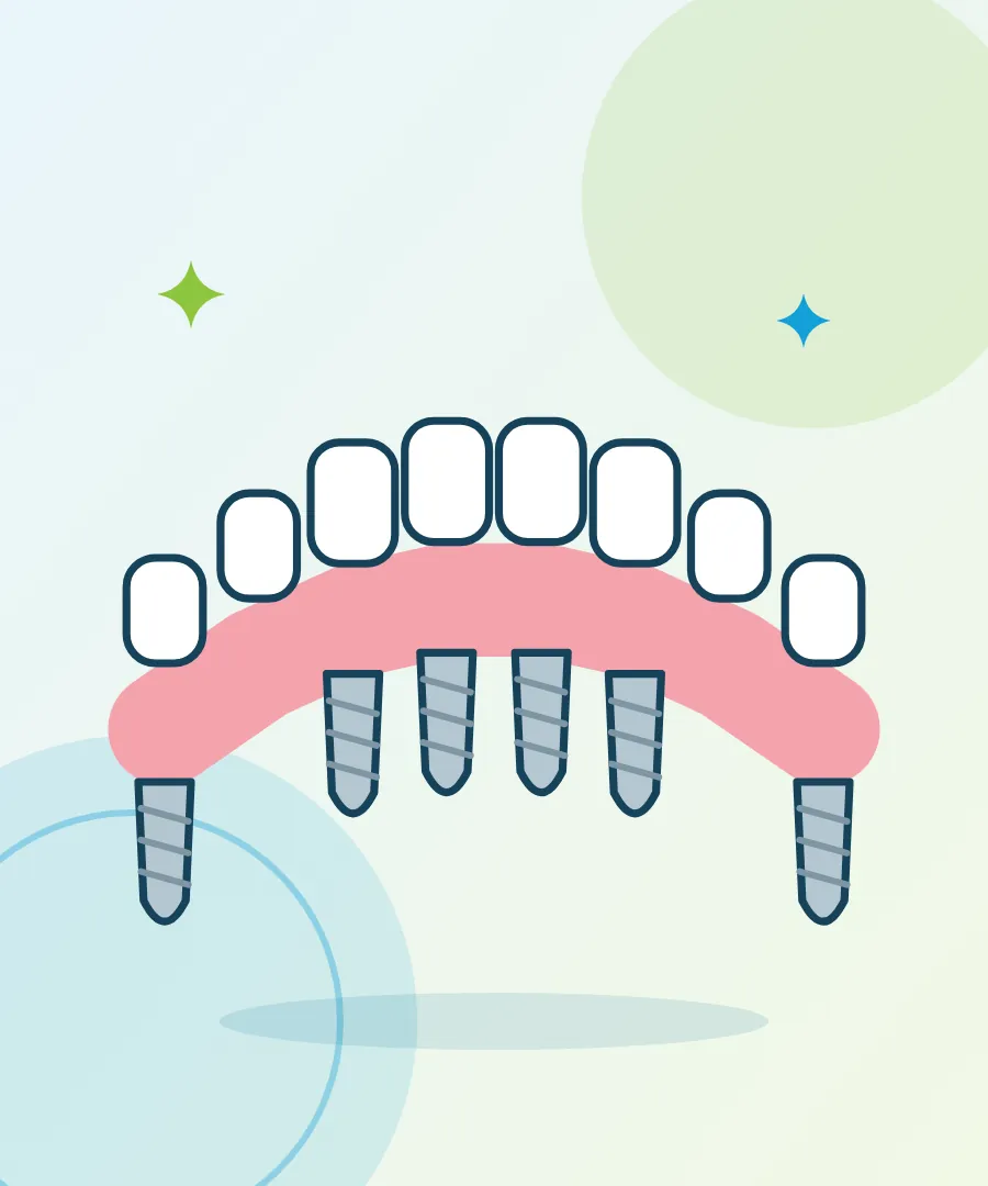 Illustration of a full arch of teeth supported by dental implants for full mouth dental implants at Sai Multi Speciality Dental Clinic, Baner