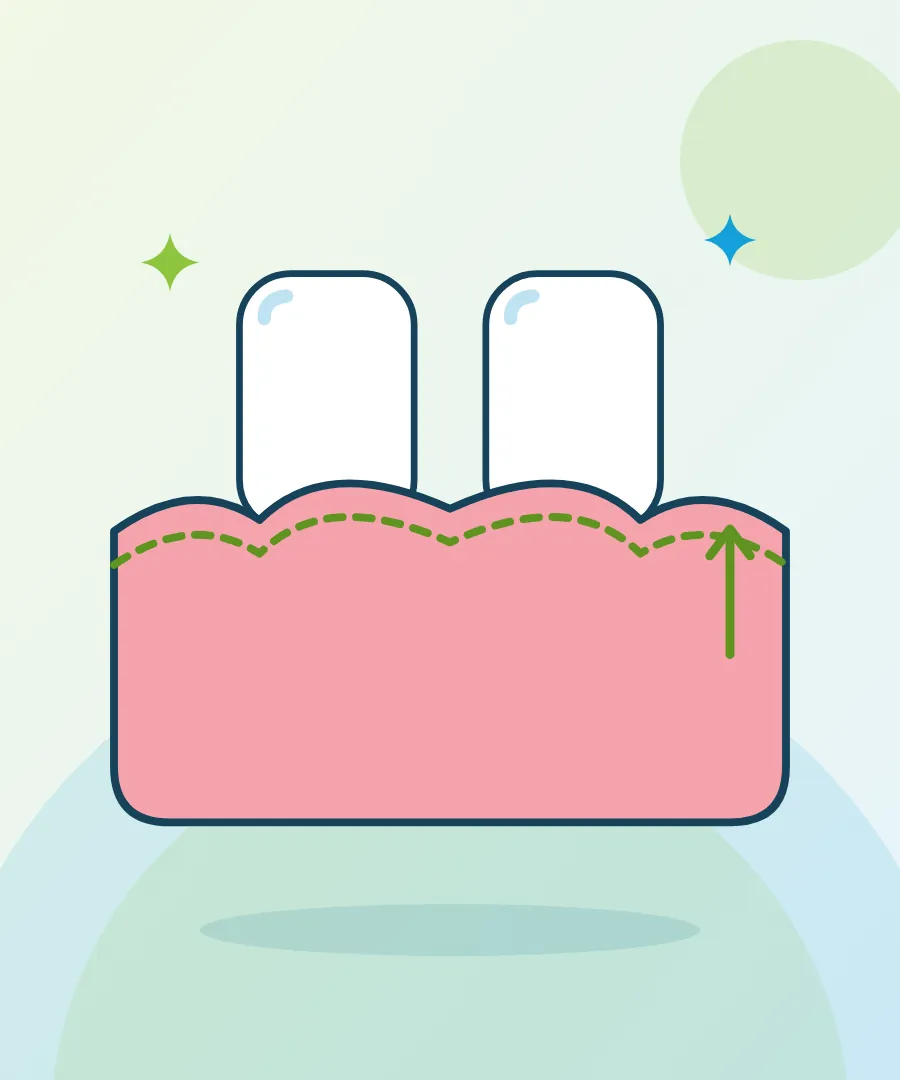 Illustration of a gum line being reshaped for gum contouring at Sai Multi Speciality Dental Clinic, Baner