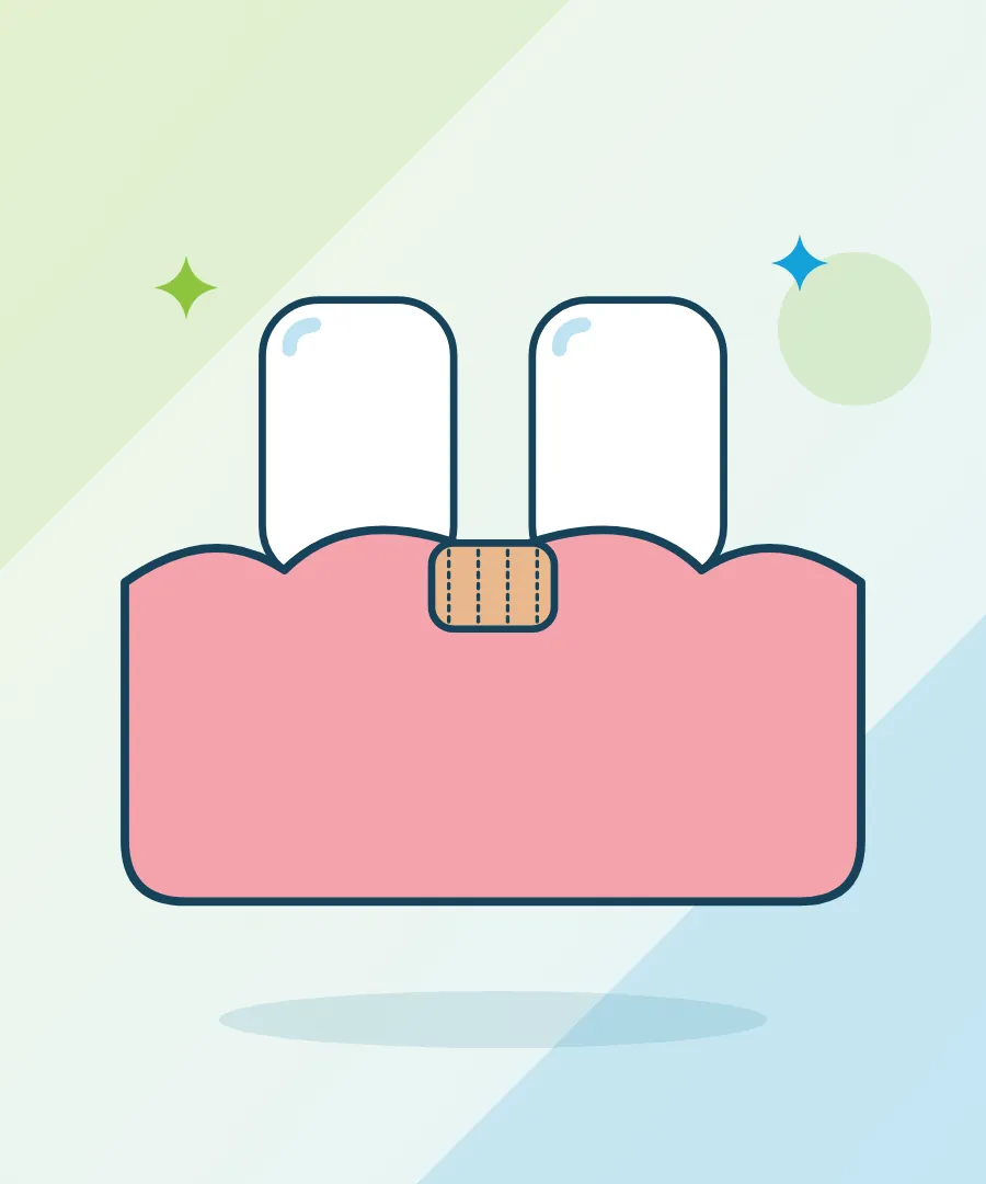 Illustration of a gum procedure on the gum line for gum surgery at Sai Multi Speciality Dental Clinic, Baner