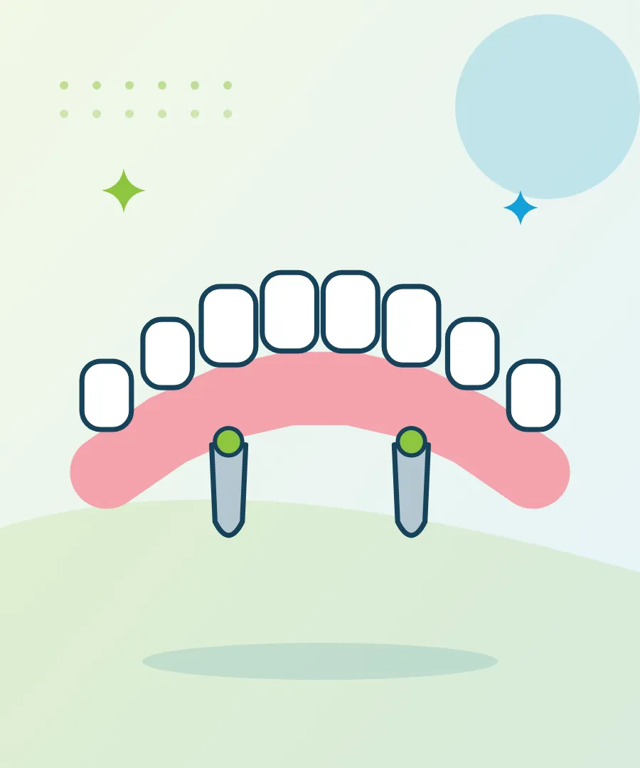 Illustration of a denture held in place by implants for implant-supported dentures at Sai Multi Speciality Dental Clinic, Baner