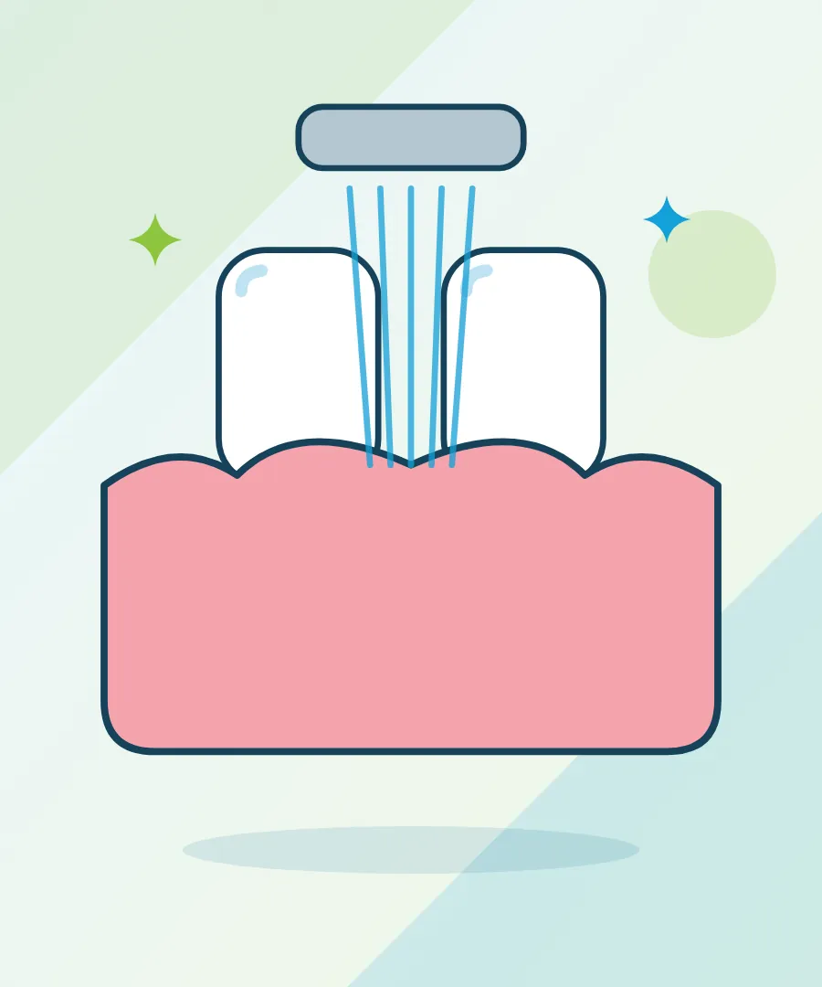 Illustration of a dental laser treating the gum line for laser gum treatment at Sai Multi Speciality Dental Clinic, Baner