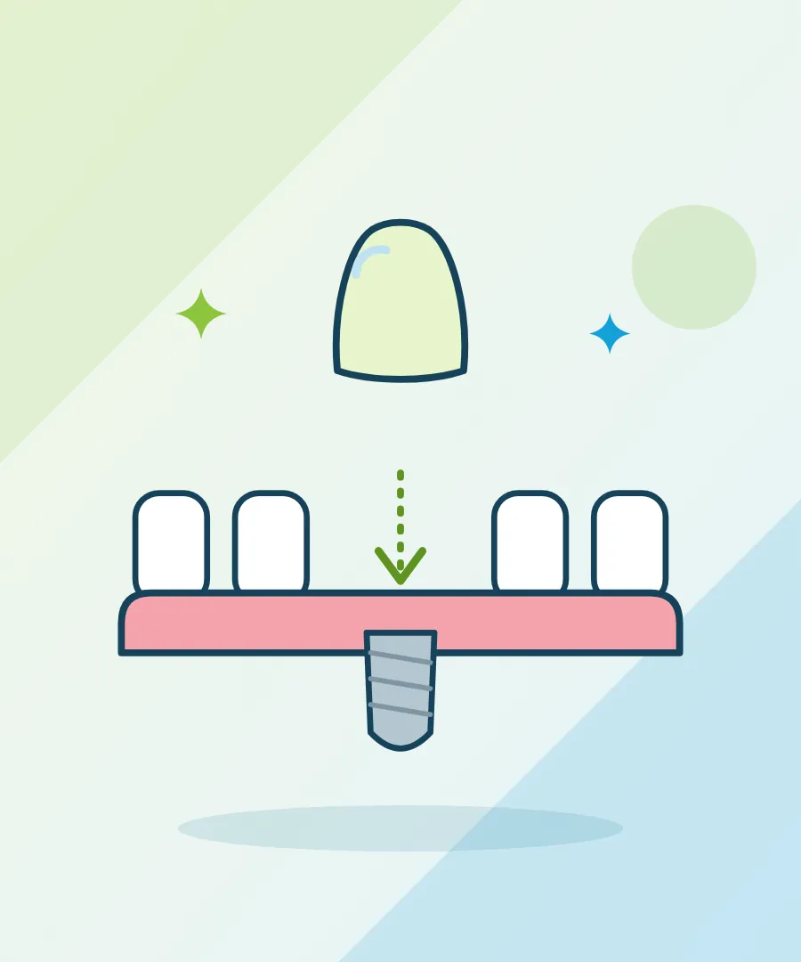 Illustration of a single implant crown filling a gap between two teeth for single tooth implant at Sai Multi Speciality Dental Clinic, Baner