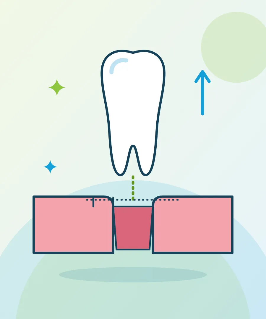 Illustration of a tooth being lifted from the gum with stitches for surgical tooth extraction at Sai Multi Speciality Dental Clinic, Baner